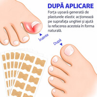 Wellife Plasturi pentru unghii încarnate, 100 buc