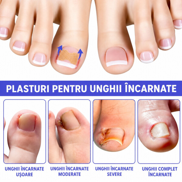 Wellife Plasturi pentru unghii încarnate, 100 buc