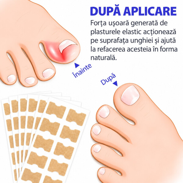 Wellife Plasturi pentru unghii încarnate, 100 buc